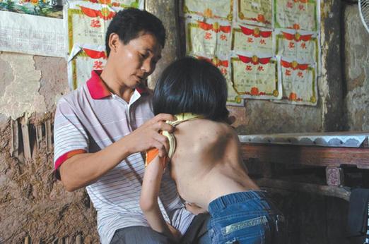 有嚴(yán)重脊椎畸形及胸腔隆突病的李文霞。