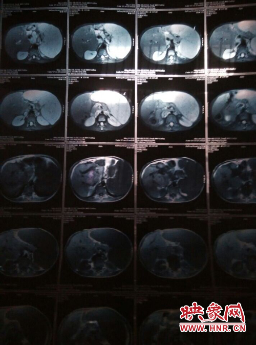 寧陵少年患病十幾年仍堅持上學 無錢治病盼救助 寧陵少年患病十幾年仍堅持上學 無錢治病盼救助