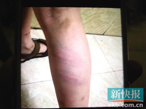 小宇腿部有明顯瘀痕。 翻拍自家屬手機