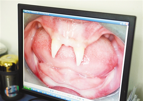 貴州：16歲男孩身患罕見(jiàn)基因病只長(zhǎng)兩顆“獠牙”