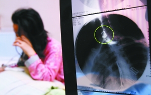 假牙上的鋼絲刺破食管，而薄薄的食道壁緊貼主動(dòng)脈血管，極易造成血管破裂