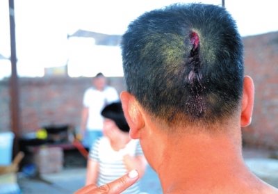 崔先生頭部受傷。京華時(shí)報(bào)記者趙思衡攝/視頻