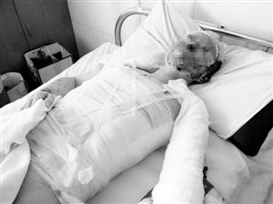 周小姐的頭、頸、軀干、四肢均被燒傷，其中面部燒傷最為嚴重。