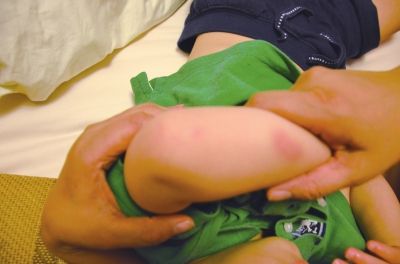 孩子身上有多處明顯傷痕。京華時報讀者供圖