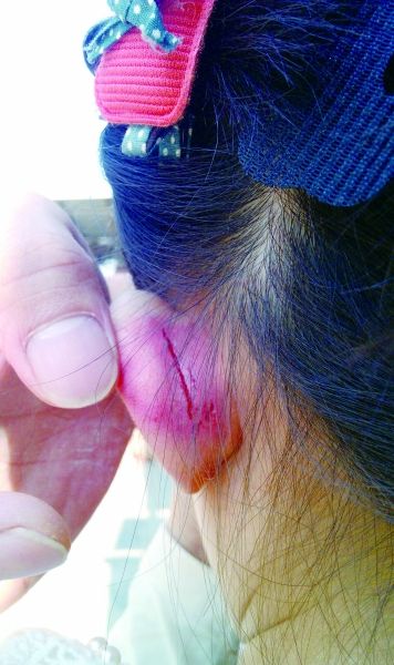 　　女童的耳朵被老師揪裂。圖片由女童家人提供