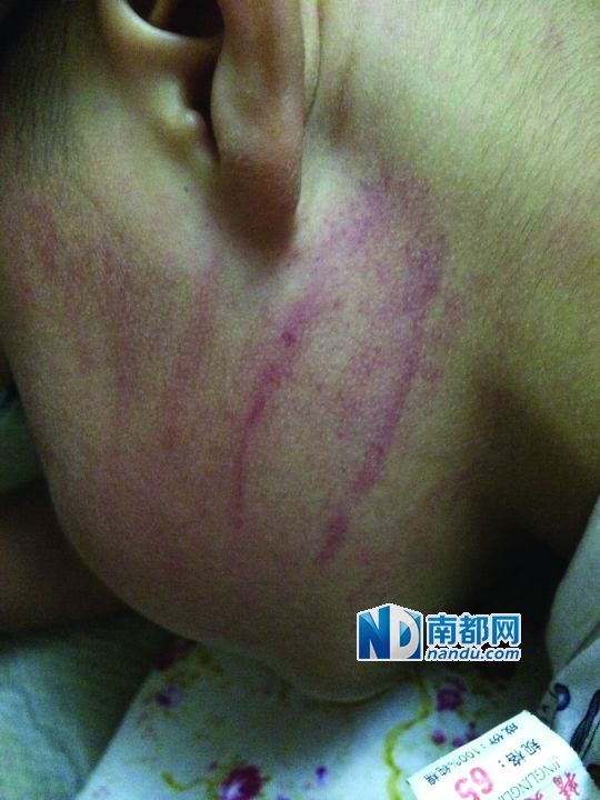 小逸臉上淤痕清晰可見。