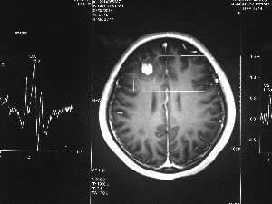 方框亮點(diǎn)為CT片顯示的異物 方框亮點(diǎn)為CT片顯示的異物