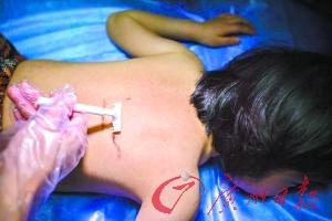 9歲女童得怪病 因服用廉價(jià)激素藥物致全身長毛