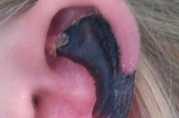 荷蘭女子旅游途中被蜘蛛咬，耳軟骨溶解變黑。