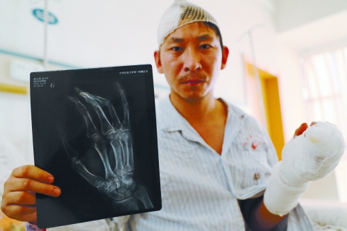 吳師傅向記者展示他的傷情 吳師傅向記者展示他的傷情