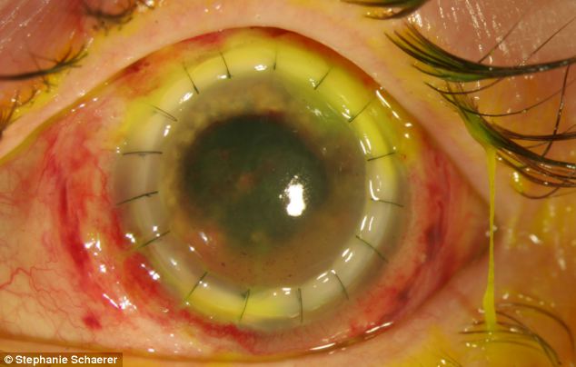 恐怖慎入！隱形眼鏡致英女子摘除眼球