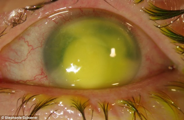 恐怖慎入！隱形眼鏡致英女子摘除眼球