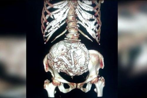 鈣化胎兒留在子宮超過半世紀 鈣化胎兒留在子宮超過半世紀