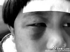 6月2日，網(wǎng)曝渭南市臨渭區(qū)一不滿5歲的女童遭奶奶毆打，眼圈青腫，引起網(wǎng)友關(guān)注，但孩子父母和爺爺均稱是摔倒導(dǎo)致。相關(guān)部門介入調(diào)查發(fā)現(xiàn)確為奶奶毆打所致，鑒于其身體原因已進(jìn)行批評(píng)教育。