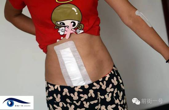 小金腹部的傷口。