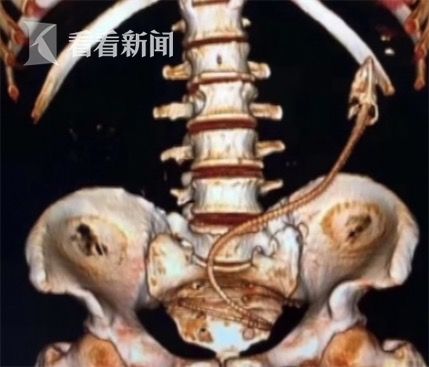 黃鱔從肛門鉆進肚子 男子被送醫(yī)不愿多談事情經過
