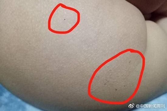 據(jù)多名紅黃藍(新天地分園)家長反映，孩子腿部、屁股、腋下出現(xiàn)針眼。