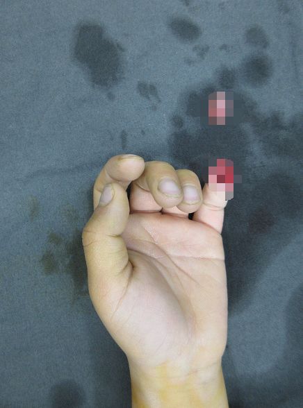 嚇哭！6歲男孩被夾斷手指 罪魁禍?zhǔn)拙故切７? oldsrc=