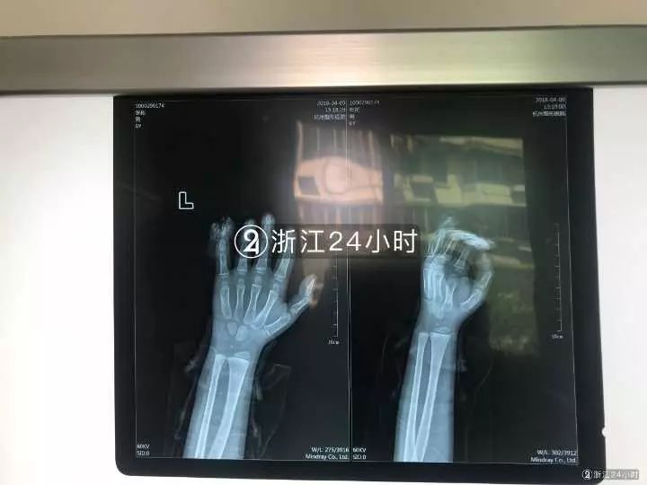 嚇哭！6歲男孩被夾斷手指 罪魁禍?zhǔn)拙故切７? oldsrc=