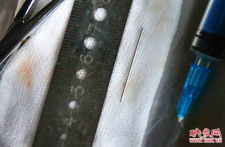 駐馬店失明雙胞胎手術(shù)成功 駐馬店失明雙胞胎手術(shù)成功