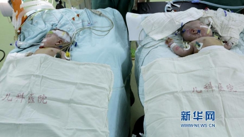 一對連體女嬰成功分離 一對連體女嬰成功分離