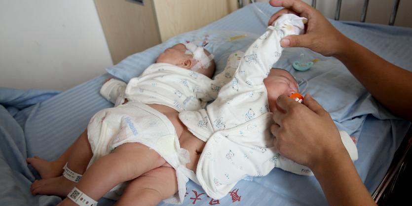 一對連體女嬰成功分離 一對連體女嬰成功分離