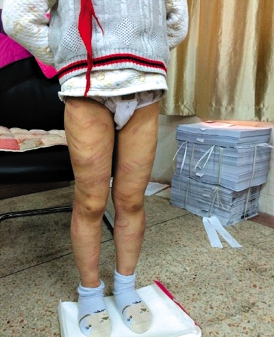 4月3日晚，微博網(wǎng)友“@朝廷半日閑”發(fā)圖文微博展示男童被虐待的慘狀。 微博截圖