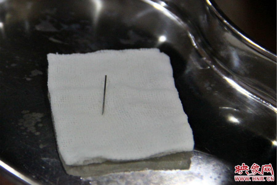 上午11點(diǎn)30分許，小龍腦中鋼針已經(jīng)成功取出。