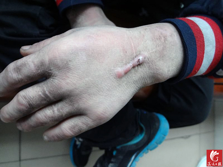 被發(fā)現(xiàn)男子手上的傷疤。