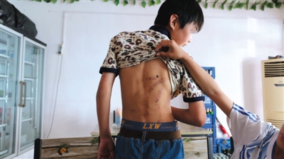 　昨日，奶西村，被打的小剛后背上條條瘀痕依然明顯。