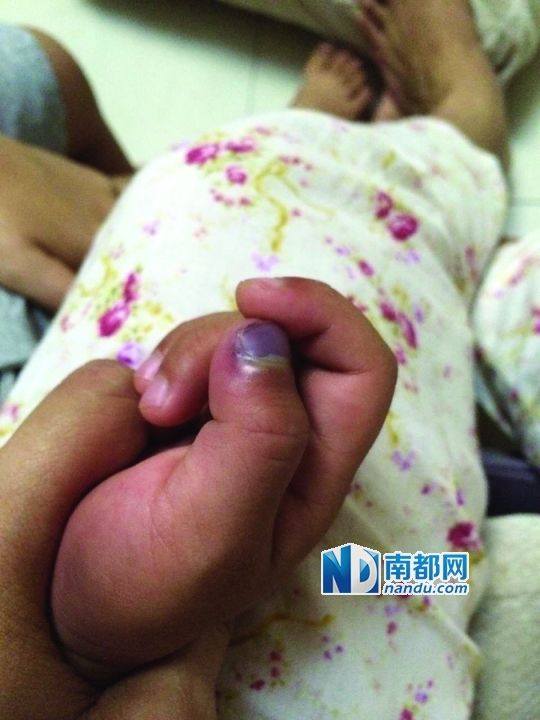 小逸手指被夾傷。