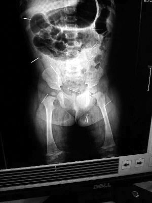 目前體內(nèi)的12根鋼針多分布在孩子的臀部，一根在腹部，其余3根在胸腔附近，其中一根很接近心臟