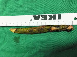 插入男子腦內(nèi)的樹(shù)枝。