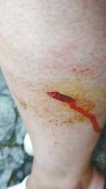 郭女士腿上被猴子咬的傷口。(受訪者供圖)