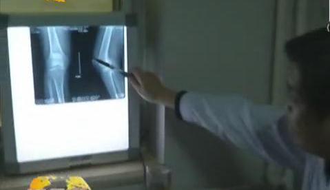 冷空氣來襲 如何預(yù)防老寒腿？