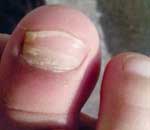 一幼兒園兒童“指甲異?！? title=